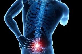 Dolor de espalda con osteocondrosis. 