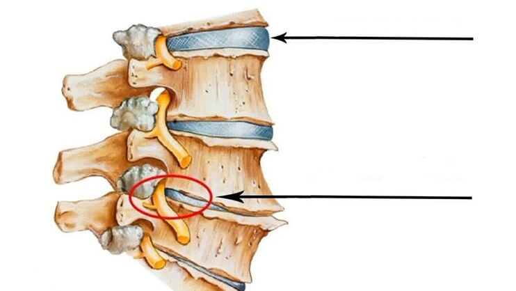 Lesión de la columna en la osteocondrosis cervical. 