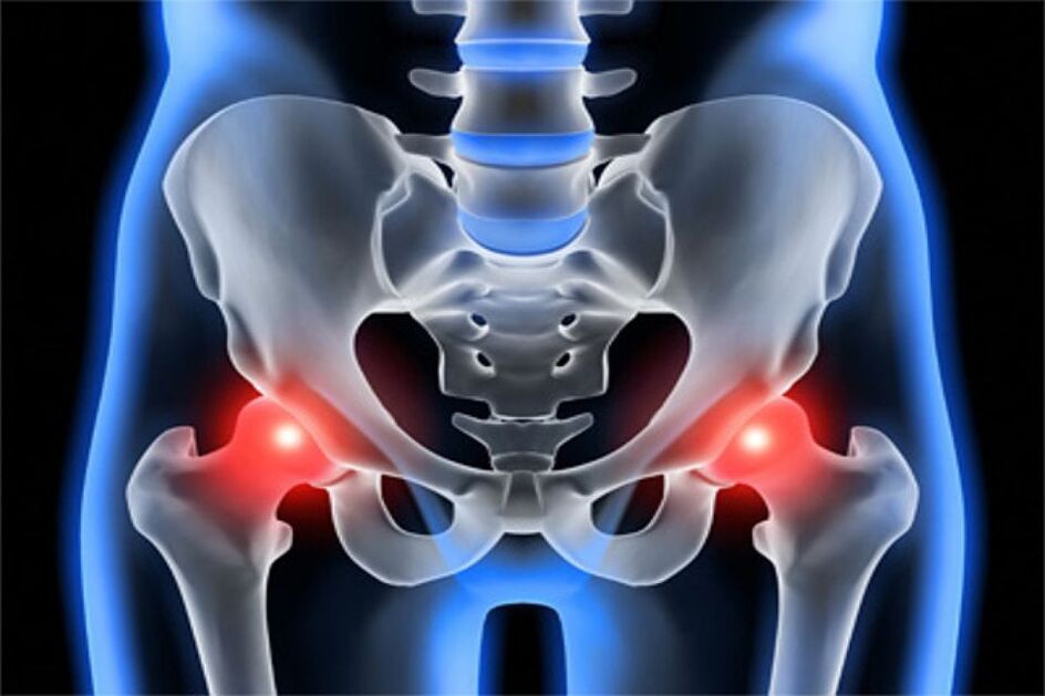 Artrosis deformante de las articulaciones de la cadera (coxartrosis)