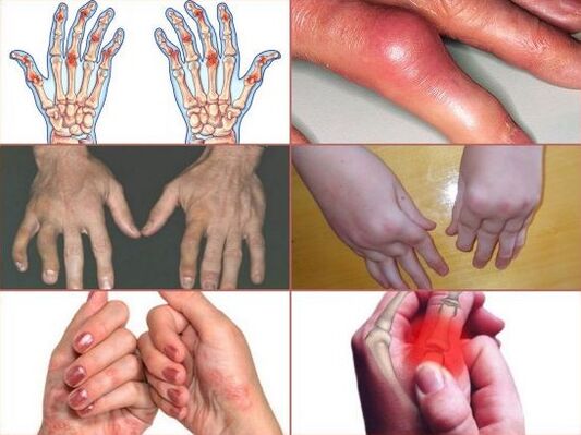 Dolor en las articulaciones de los dedos