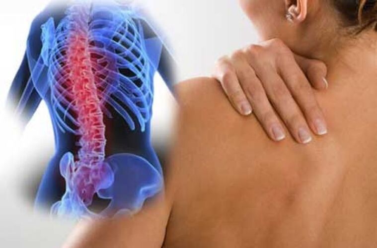 Con una exacerbación de la osteocondrosis de la columna torácica, se produce dolor en el dorsago. 