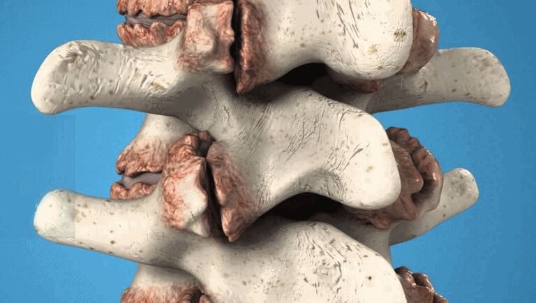 Los osteofitos de la columna vertebral como causa del dolor de espalda
