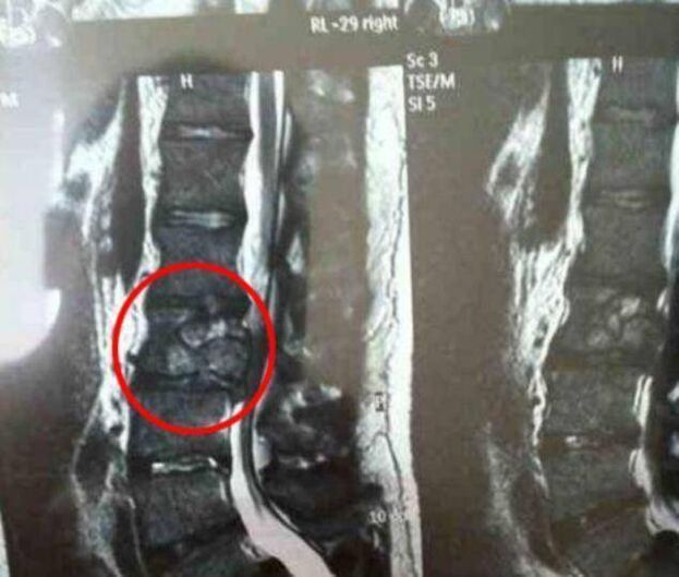Tumor espinal como causa de dolor de espalda
