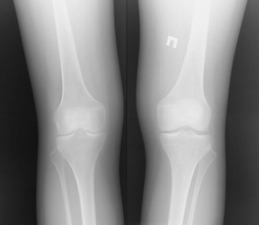 La imagen x -ray de la articulación de la rodilla
