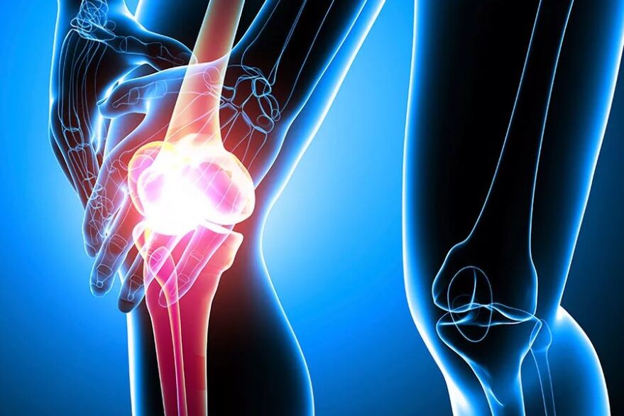 Osteoartritis de rodilla