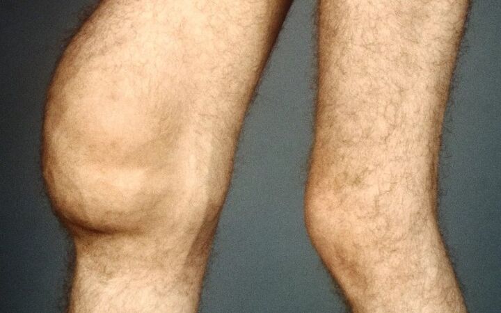 Osteoartritis post -trraumática de la articulación de la rodilla