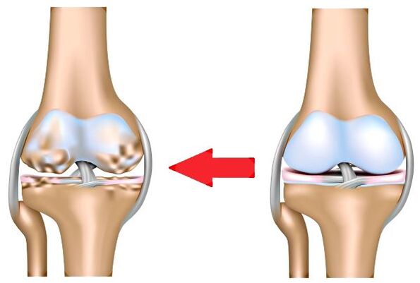 Articulaciones sanas y osteoartritis