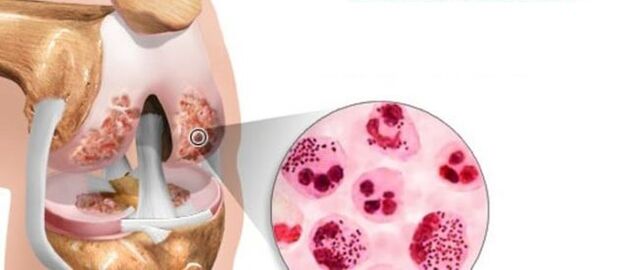 Esto lleva al desarrollo de la osteoartritis