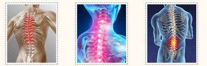 Lesiones de columna de osteocondrosis