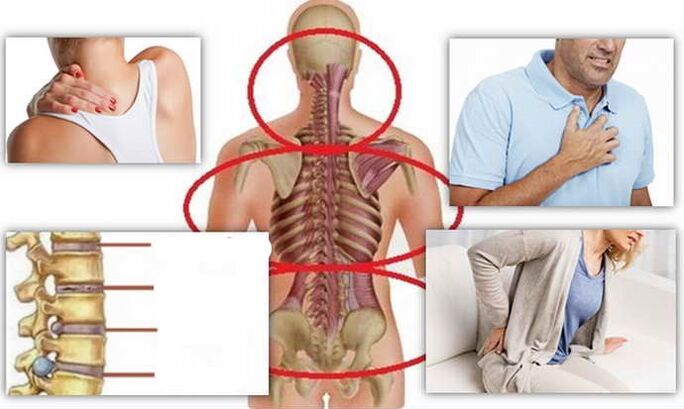Ubicaciones de la enfermedad para la osteocondrosis