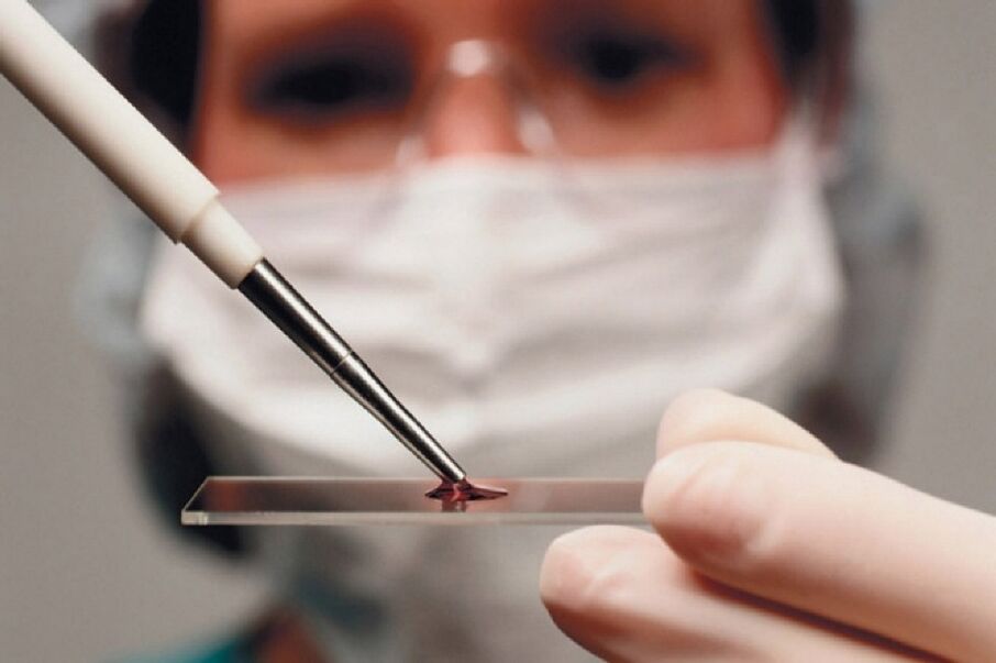 La artritis es una enfermedad inflamatoria cuya presencia se determina mediante análisis de sangre.