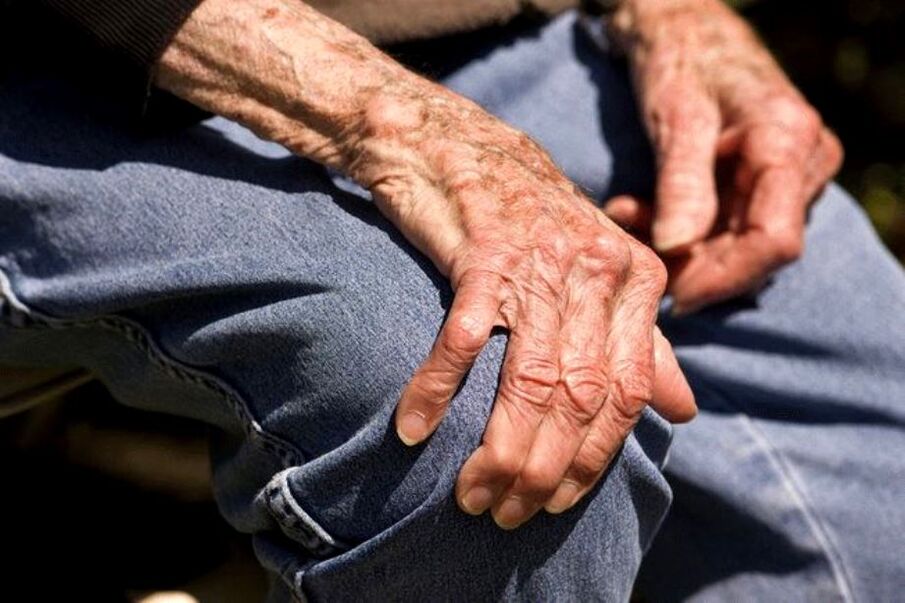 La osteoartritis es una enfermedad relacionada con la edad que se presenta en personas mayores.