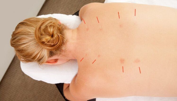 Acupuntura para la osteocondrosis torácica, que tiene muchos beneficios.