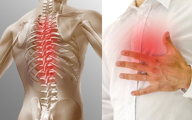 La osteocondrosis torácica se manifiesta como dolor y sensación de opresión en el pecho.